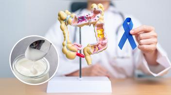 Estos dos alimentos podrían prevenir el cáncer de colon, según expertos