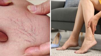 ¿Piernas hinchadas, sensación de pesadez o várices? Estas vitaminas pueden estar faltándote