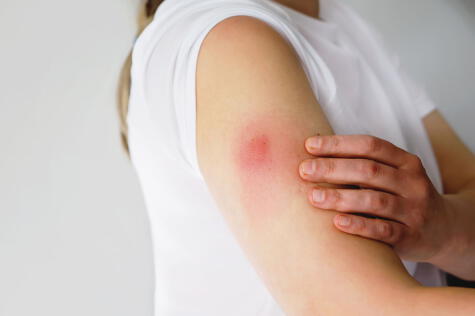 La irritación de la piel es un efecto secundario leve y muy común.    