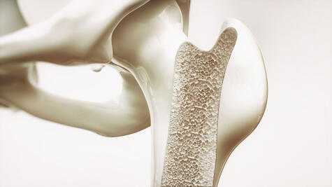 La osteoporosis debilita los huesos; por eso es importante el consumo de calcio en la adultez.   