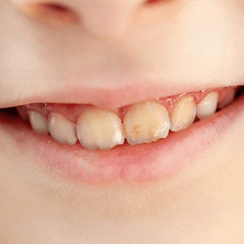 El consumo de ácido acética debilita los dientes. El consumo de ácido acética debilita los dientes.