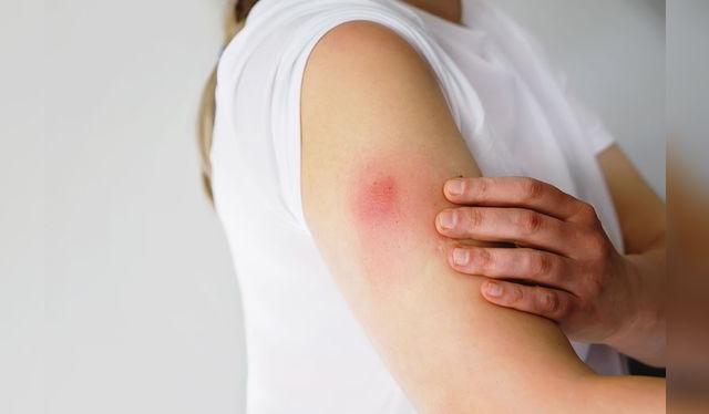 La irritación de la piel es un efecto secundario leve y muy común.    