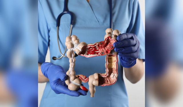 Una dieta rica en fibra y antioxidantes ayuda a reducir el riesgo de cáncer de colon.   