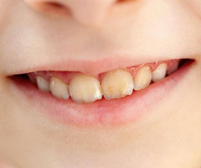 El consumo de ácido acética debilita los dientes.   