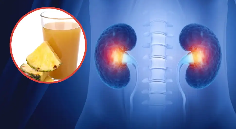 Agua de piña: ¿Qué efecto tiene en los riñones? Agua de piña: ¿Qué efecto tiene en los riñones?